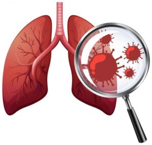 TB and Lungs